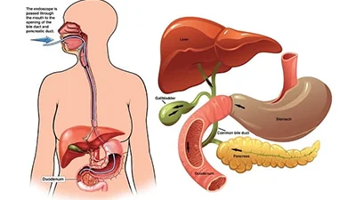 Endoscopic Ultrasound (EUS)